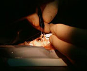 La cataracte en chirurgie ambulatoire
